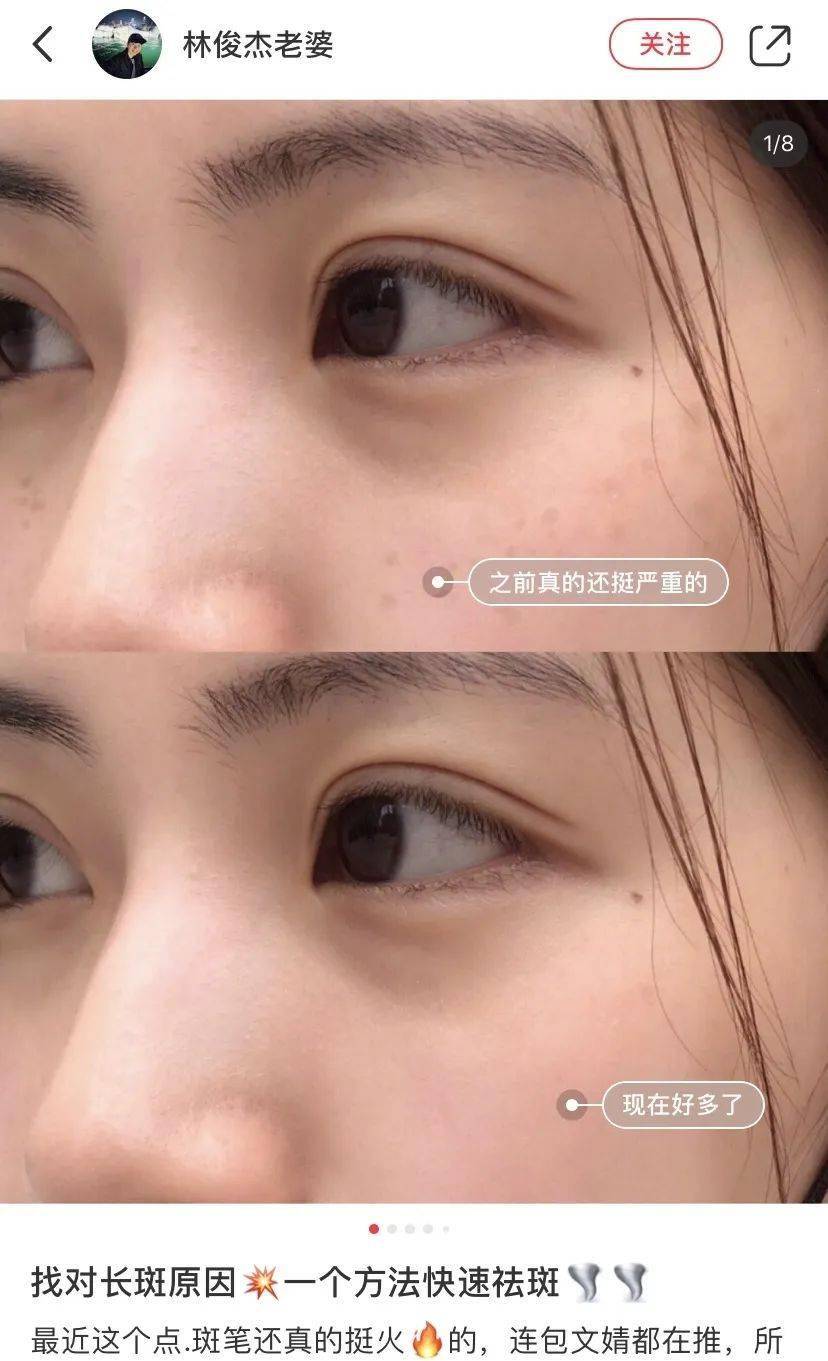 皮肤|用它点一点，痘印、斑点竟然没了，难怪李佳琦都为它疯狂打call！