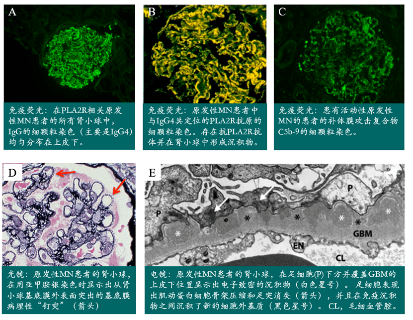mn最初是通过光学显微镜观察肾小球毛细血管壁的增厚(膜状)外观而