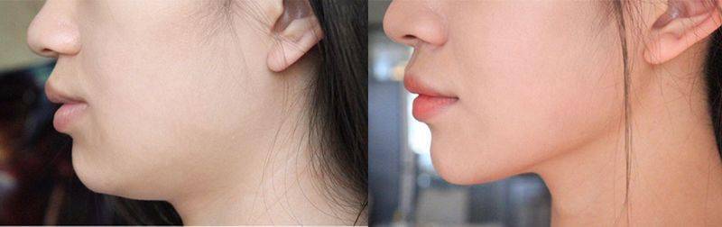 效果|这个比瘦脸针还好用的好物，既消水肿又提拉紧致，立变小V脸！