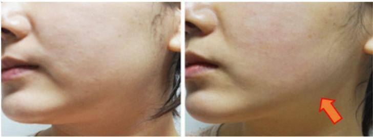 效果|这个比瘦脸针还好用的好物，既消水肿又提拉紧致，立变小V脸！