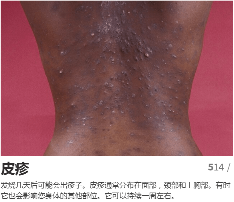 艾滋病是怎么把我们击垮的