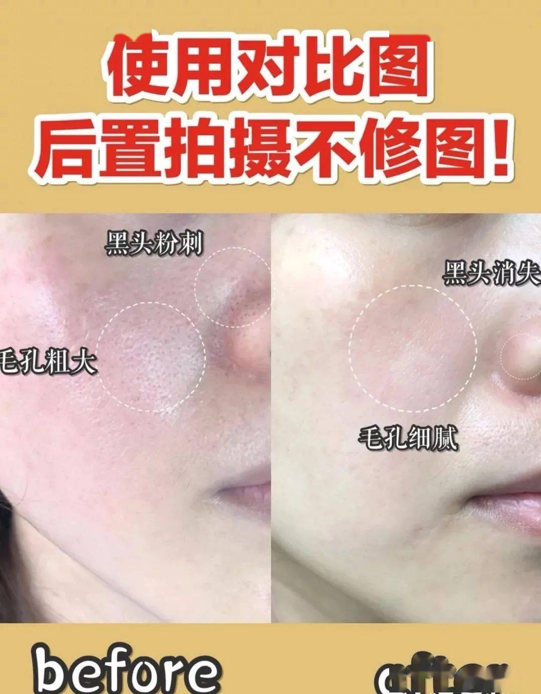 毛孔|鼻子脏到挤出“白条条”?照我这样做,脸上啥脏东西都溶掉!