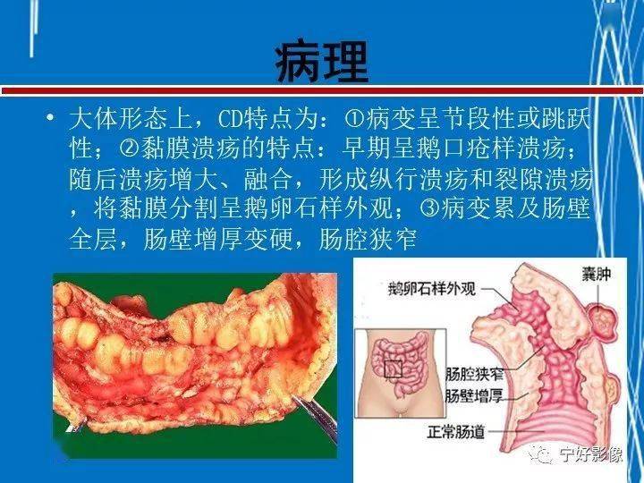 克罗恩病ct,mri表现及鉴别诊断