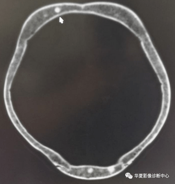 4,脑膜瘤:可引起邻近颅骨内板骨质增生或破坏改变,ct扫描可见颅内有