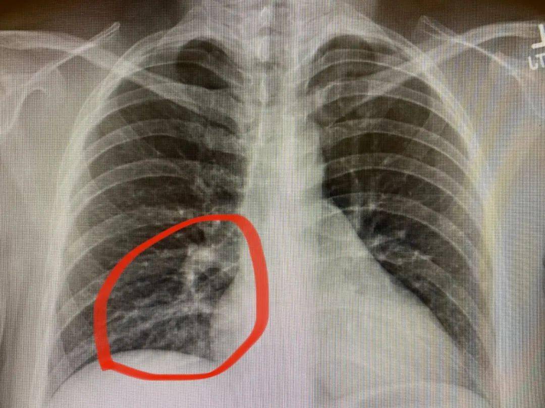 胸片显示右下肺炎有轻度的浸润病灶