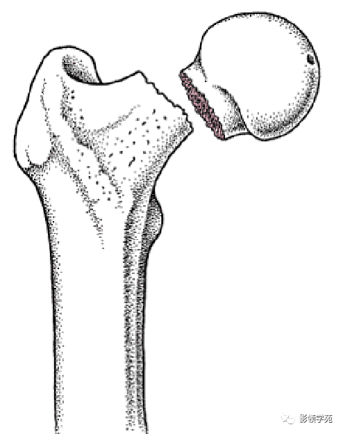 股骨颈骨折影像表现