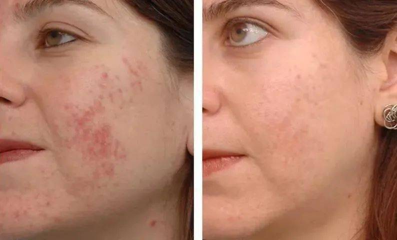 祛痘|30秒get医美“刷酸” ，从此和痘痘大毛孔形同陌路！