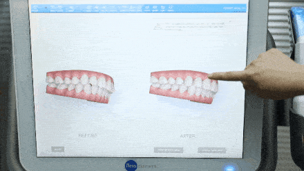 口腔|整牙比整容还要厉害？不动刀，不打针，悄悄变美的秘密就在这里！
