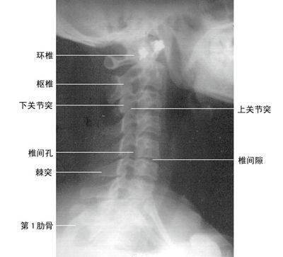 颈椎后前斜位像②椎体向后方延伸的结构为近片侧椎弓根,近片侧椎弓根