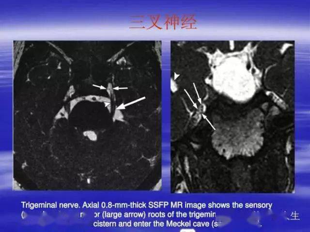 mri图像中可以看到的八条颅神经