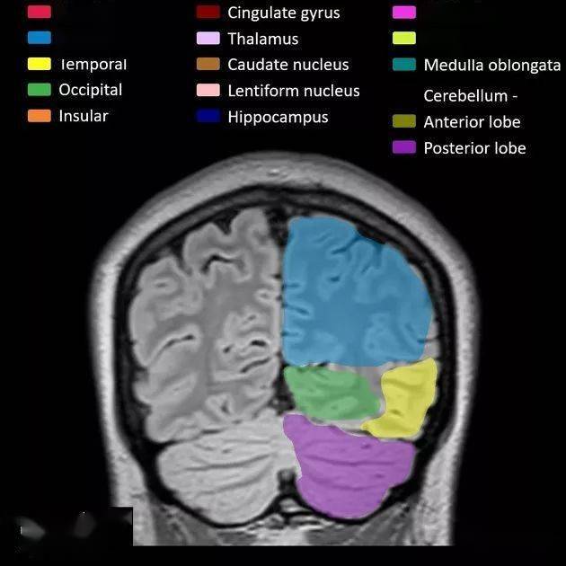解剖丨脑叶分布mri图像彩色标注