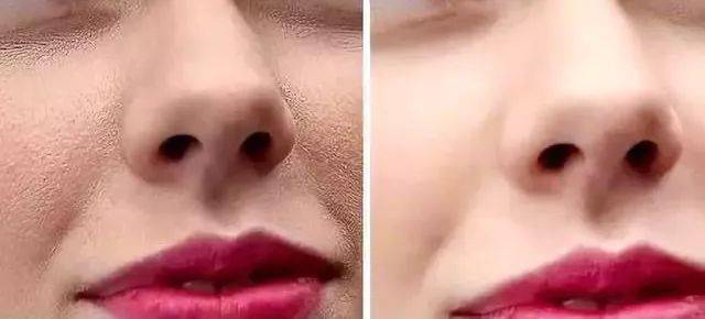 肌肤|脸上挤出的“白浆”是什么？原来是它作怪！出油、过敏也因此而起！