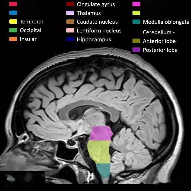 解剖丨脑叶分布(mri图像彩色标注)