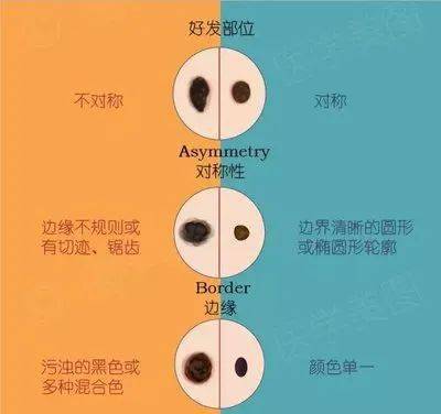 身上长这5种痣,特容易癌变!你身上的有这些痣最好去掉