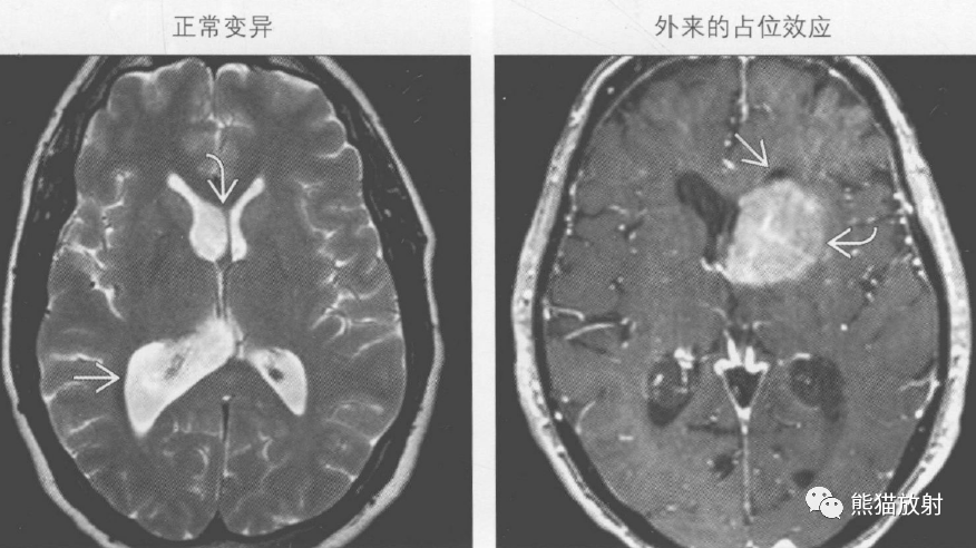 胎儿脑室不对称怎么办