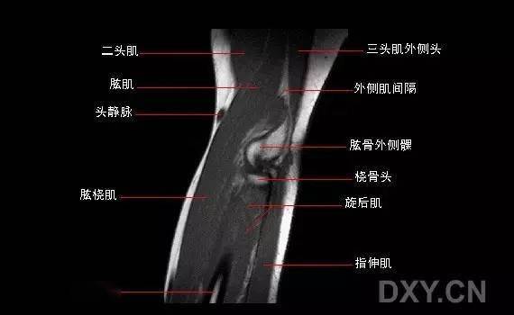 正常肘关节矢状位mri2正常肘关节冠状位mri1急诊开出来的那些mri单子