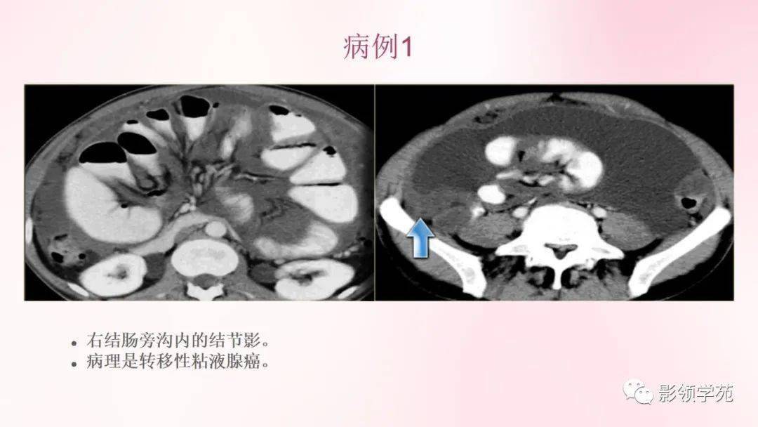 膜及肠系膜病变的影像学表现