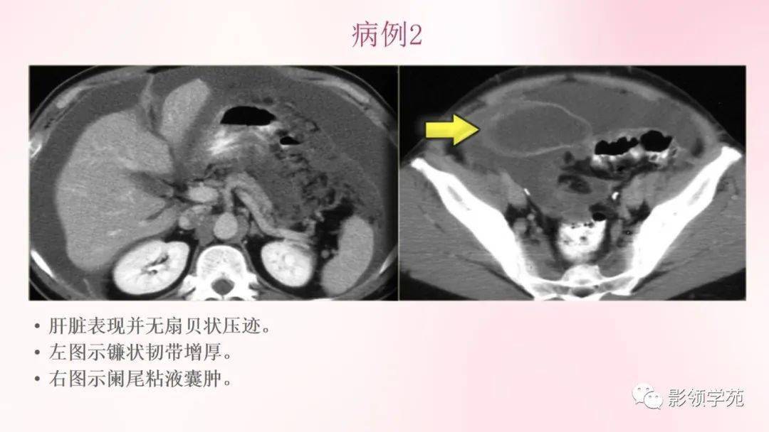 膜及肠系膜病变的影像学表现