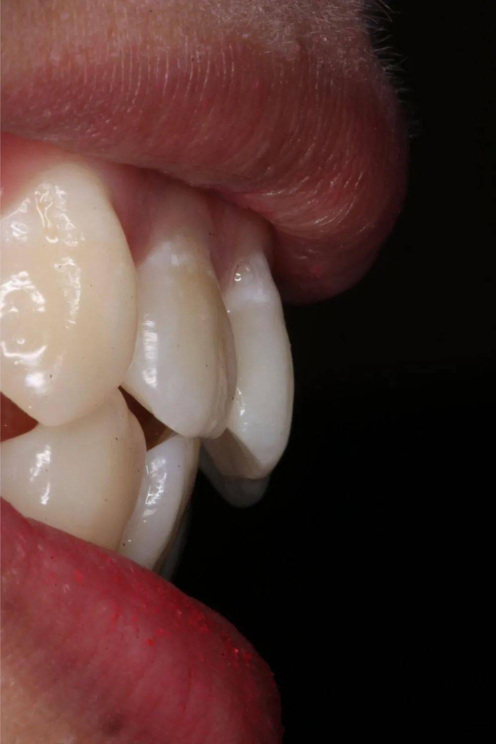 龅牙|广州95后女生从小龅牙，嘴巴都快闭不上！朋友却劝她不要矫牙，一年后......