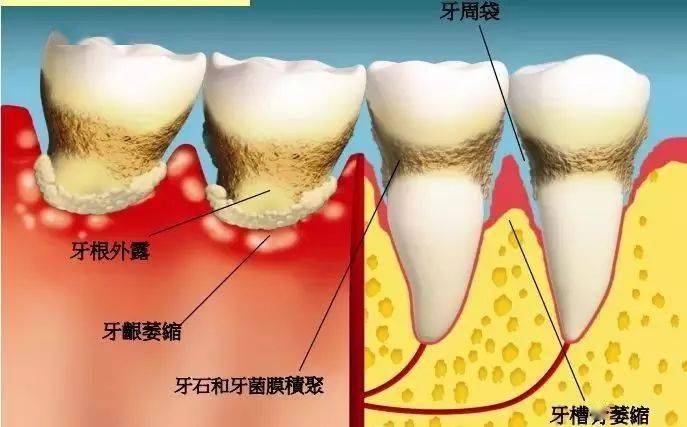 什么是牙周病及症状表现 374af9df926446beba78f6de1622db5b.jpeg
