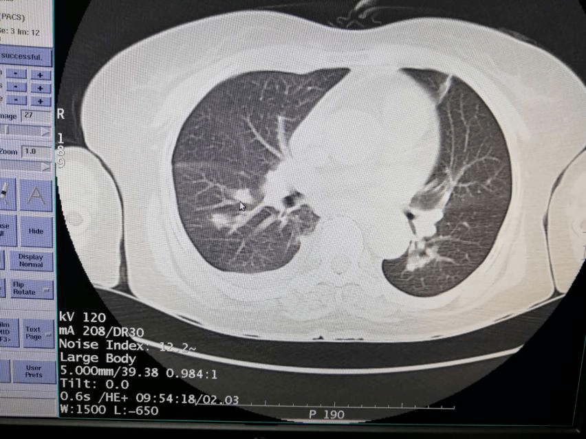 右侧胸腔积液增多.