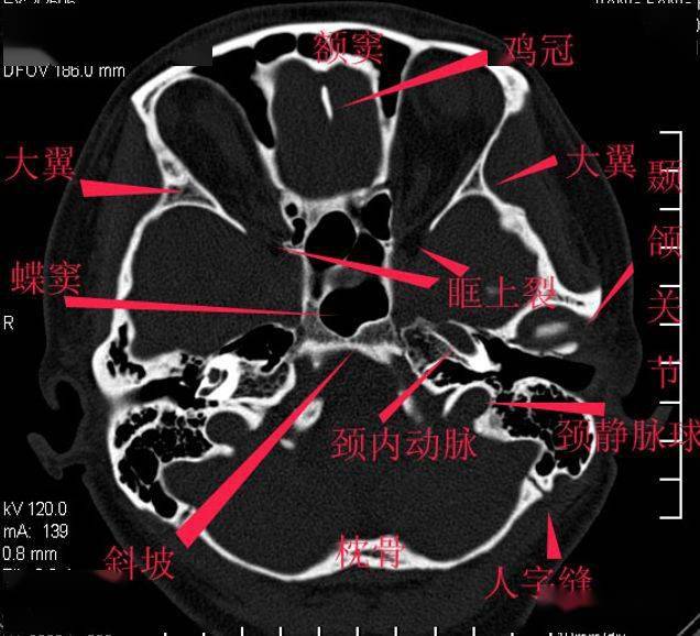 颅底详细断层解剖