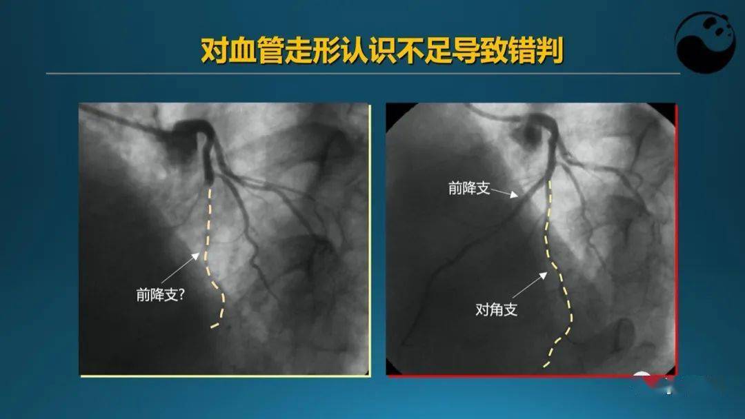 从零开始教你全面剖析冠脉造影结果