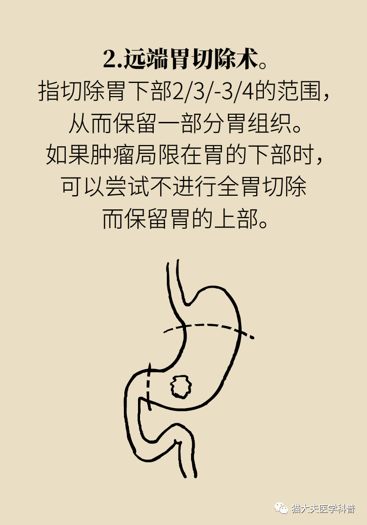 胃癌手术一定要全切胃光把肿瘤挖掉行不行