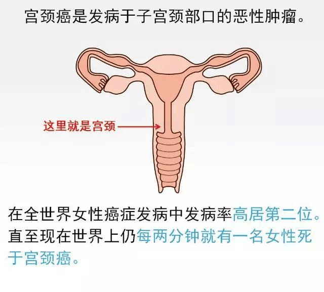 出现这5个警示,当心宫颈癌来袭