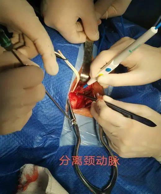 我院神经外科顺利开展颈动脉内膜剥脱术