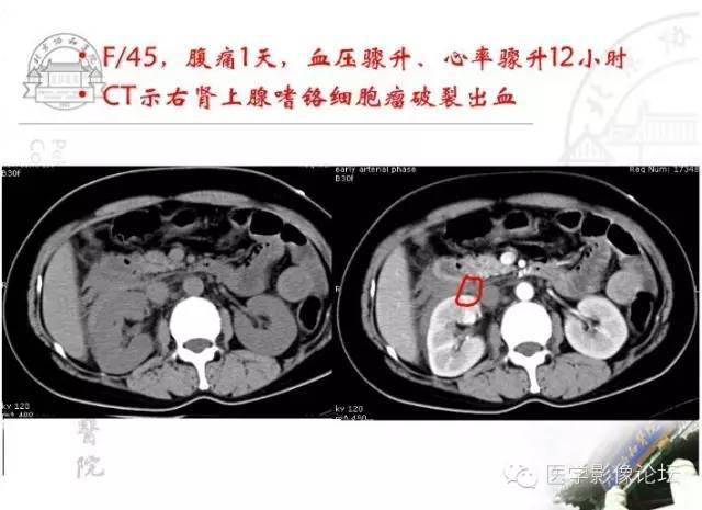 可用于所有急腹症检查,价值较 4,超声检查:实质性脏器外伤,腹腔积液