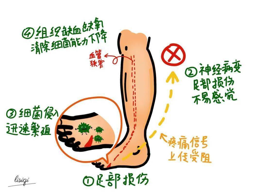 贺州人 烂脚,截肢,糖尿病足你怕了吗?