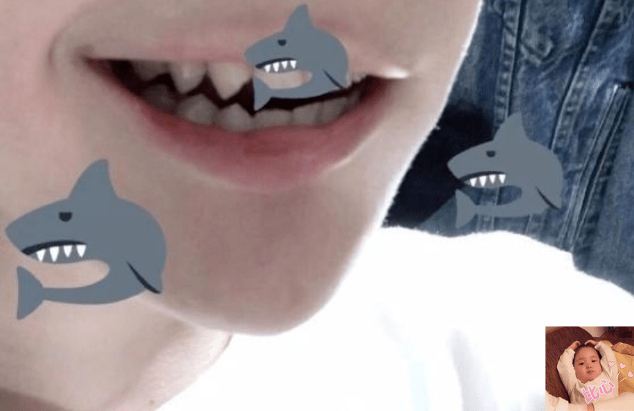 宝宝张嘴露出两排"鲨鱼牙",表面霸气实则害娃,正确护牙很重要