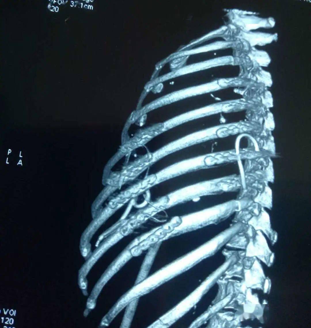 为什么肋骨骨折CT扫描一定要做三维成像-MedSci.cn