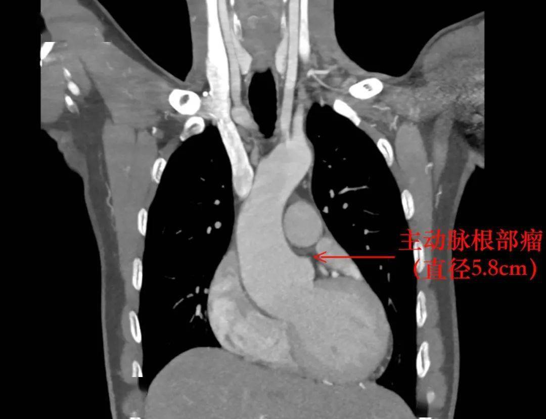 患者|一家三人都是高个子、大长腿，竟然是这种可怕的遗传病！