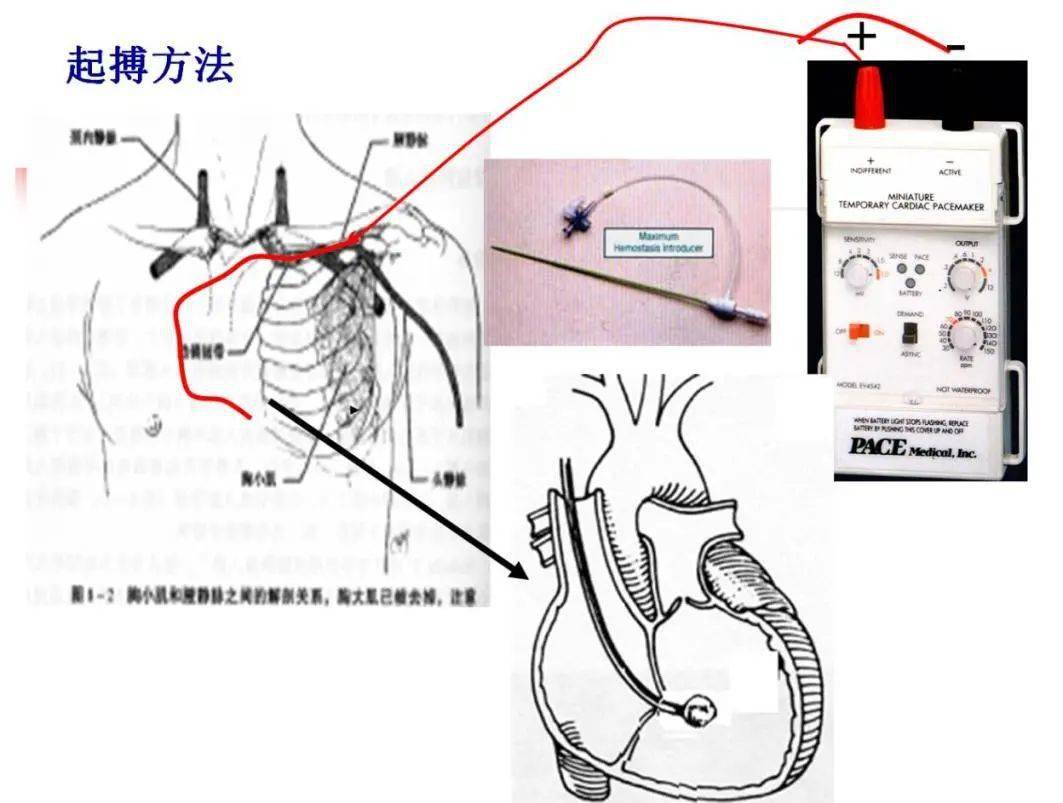 采用植入临时人工心脏起搏器,以提高心率,增加心排量,改善冠脉灌注和