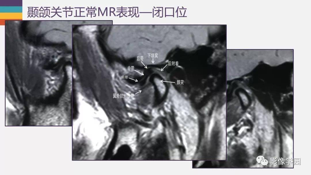 颞颌关节病变的mri诊断