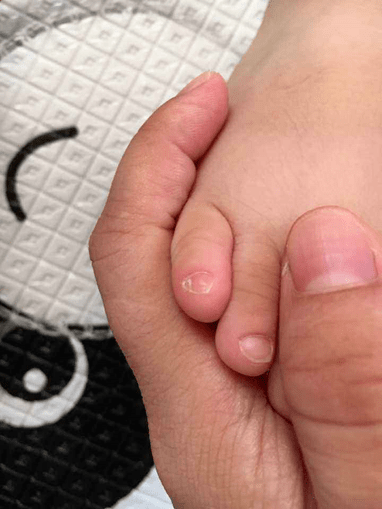 白点|孩子指甲上的月牙、白点、竖纹、分层、咬指甲......是有大病的征兆？
