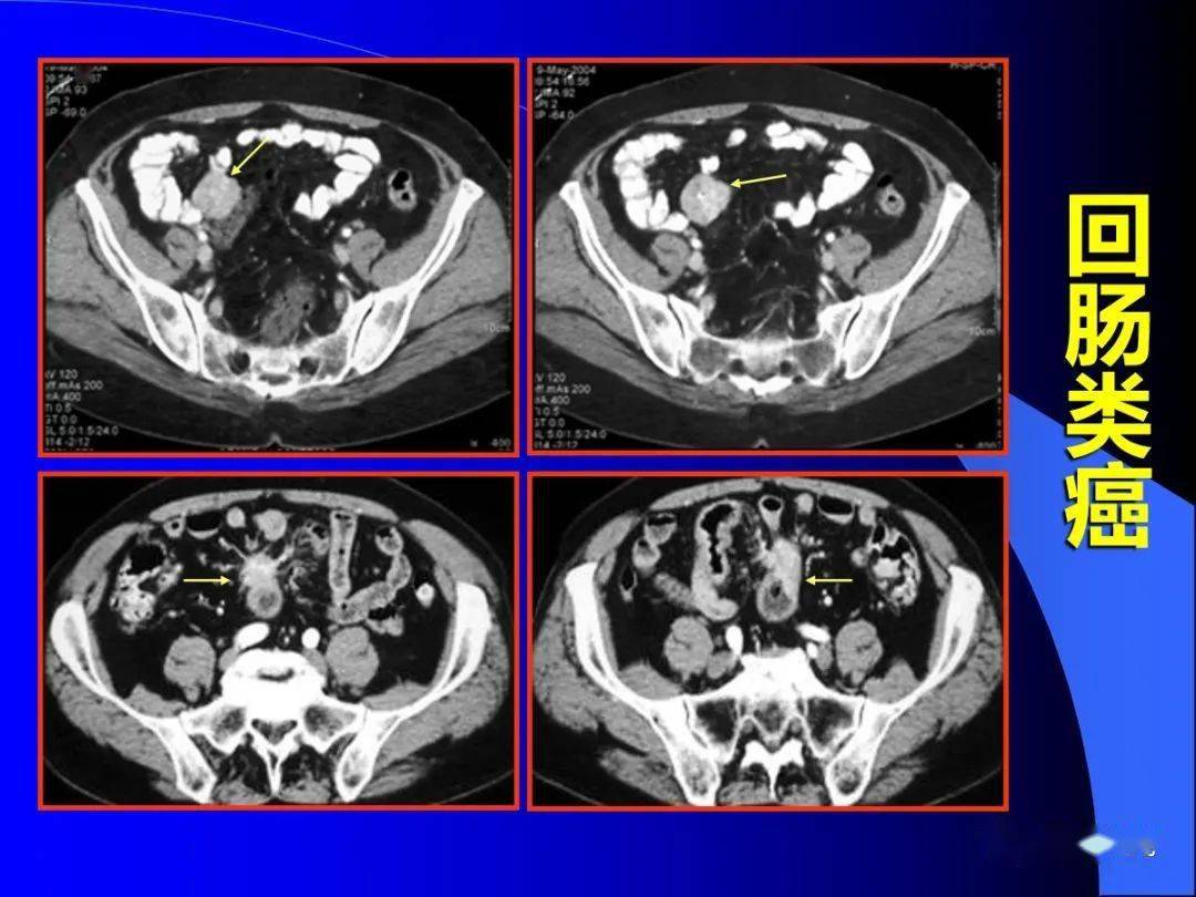 小肠良恶性肿瘤的ct诊断