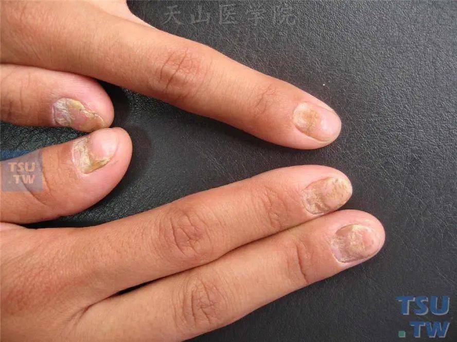 指甲变形竟然是癌关于指甲的这些暗示你知道吗