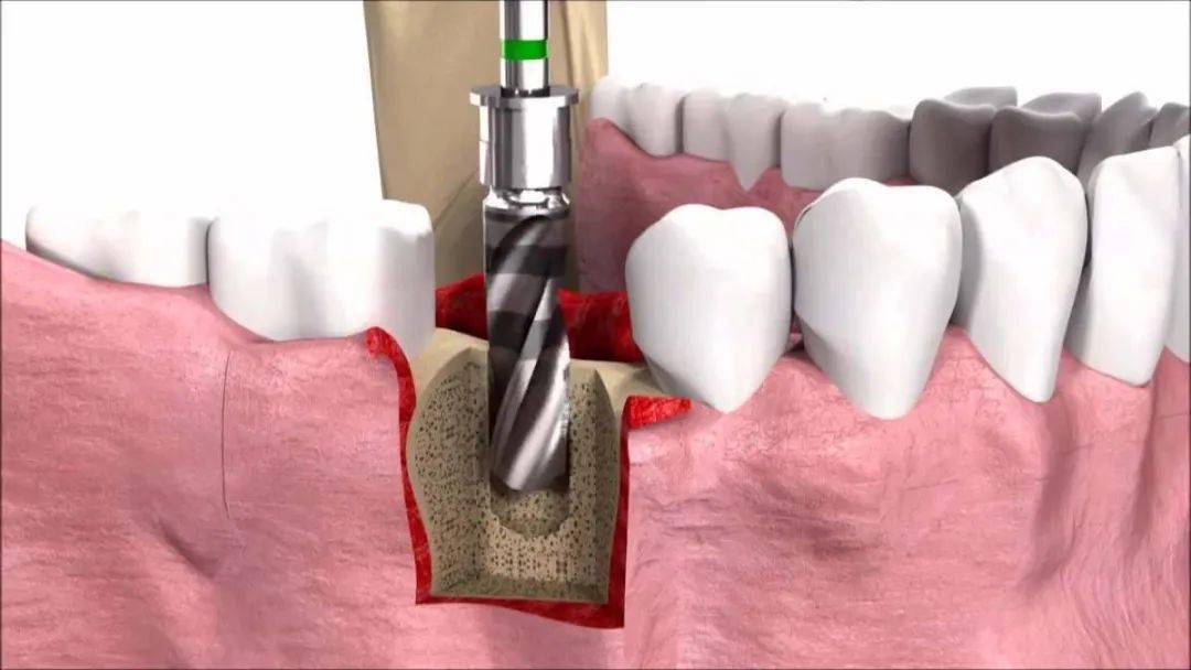 3,固位好:不使用传统镶牙的卡环或牙套,人工牙根牙槽骨紧密结合,像
