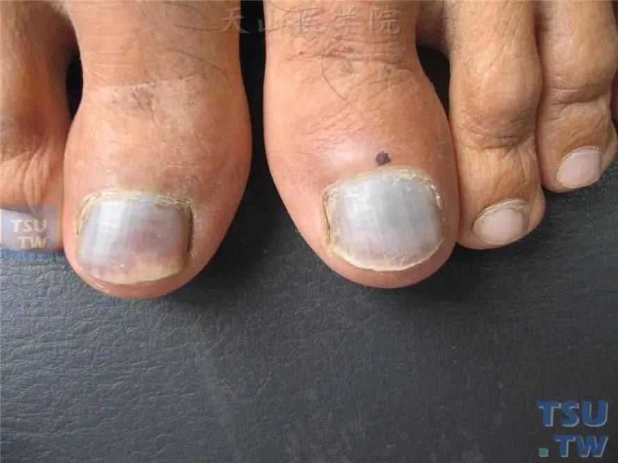 指甲变形竟然是癌,关于指甲的这些"暗示"你知道吗?