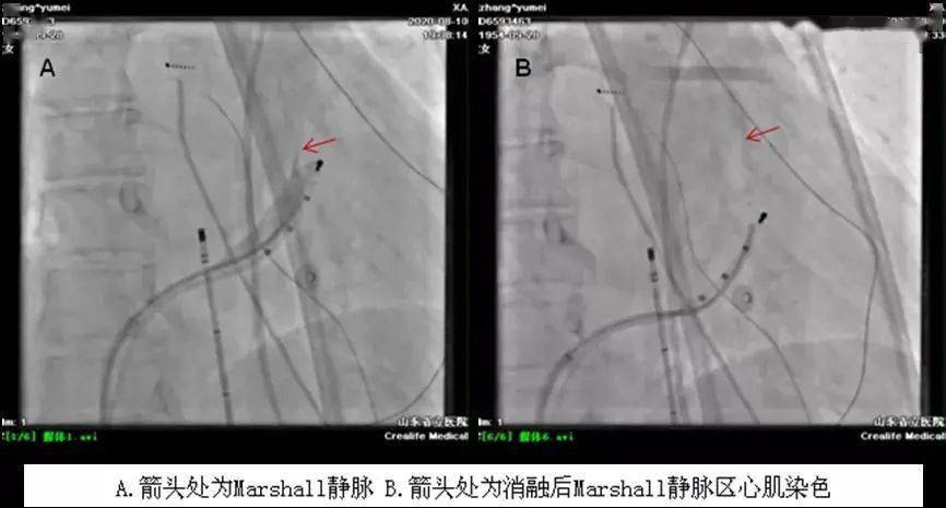 附院在线 | 山一大附属省立医院开展首例经导管marshall静脉无水酒精