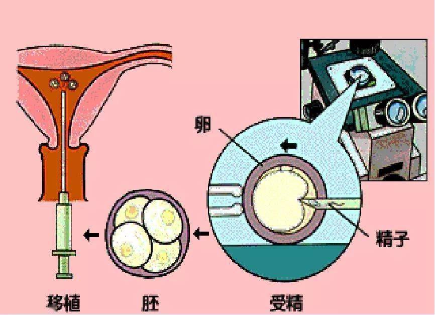 怎样选择助孕方式?