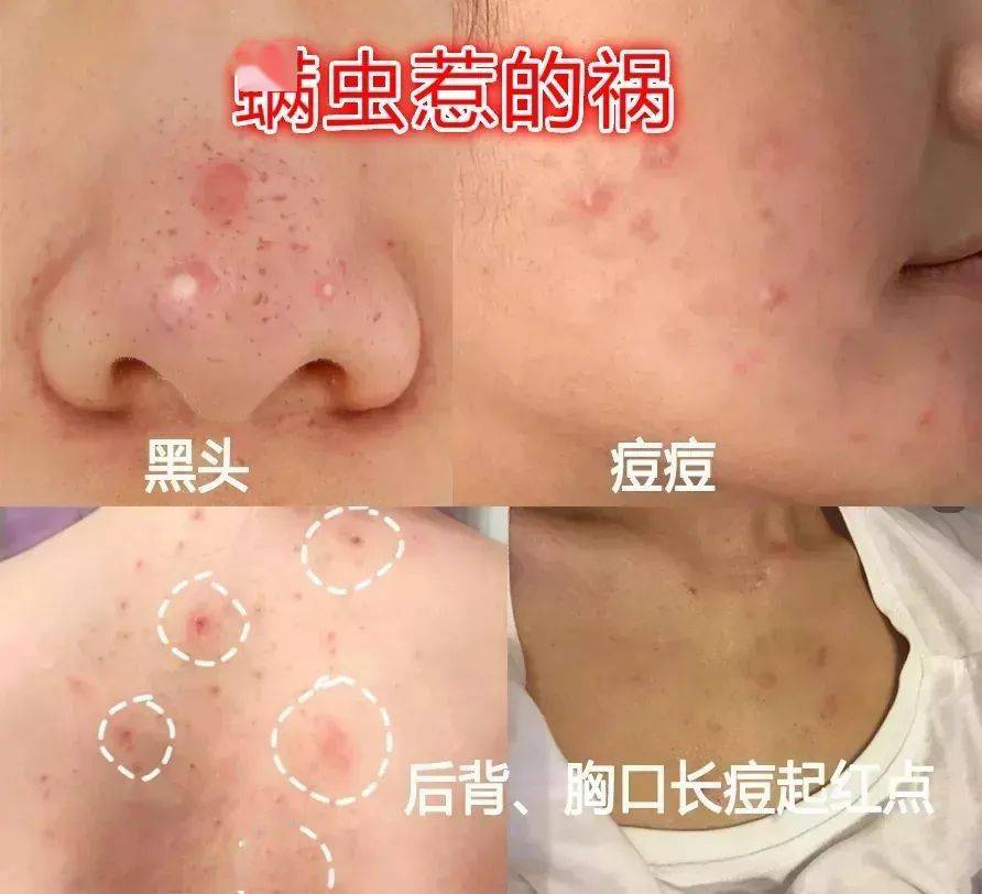 痘痘|背上长痘？神奇“液体”硫磺皂，60秒揪出万千螨虫，李佳琦卖了3万瓶！