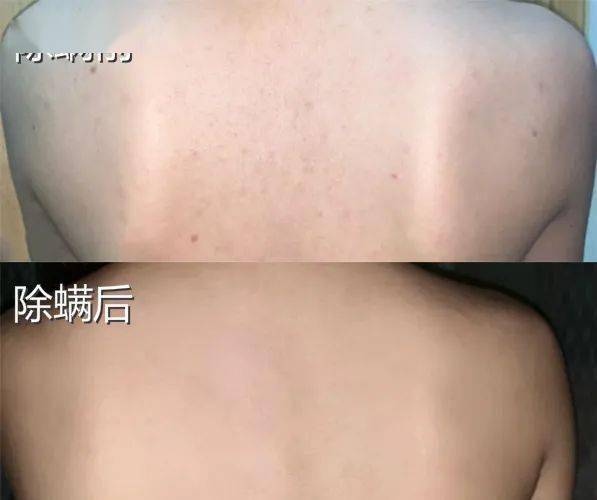 痘痘|背上长痘？神奇“液体”硫磺皂，60秒揪出万千螨虫，李佳琦卖了3万瓶！