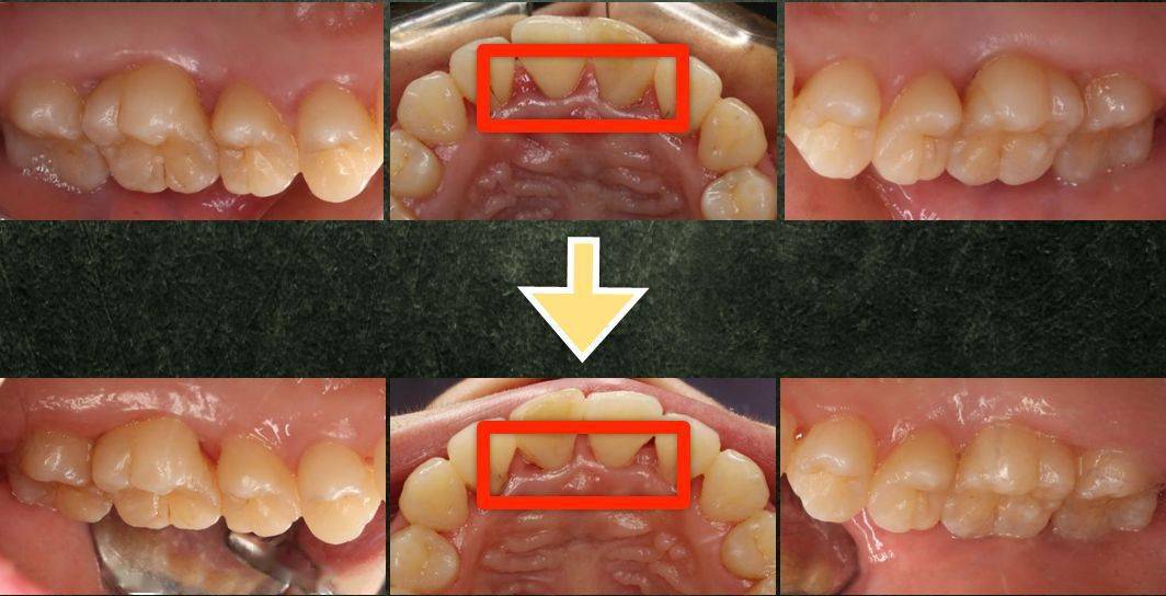 局限型侵袭性牙周炎及牙龈退缩治疗病例分享