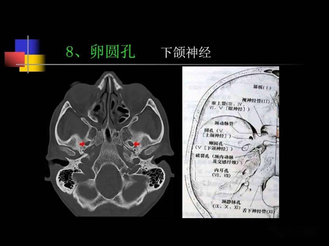 鼻咽部ct解剖