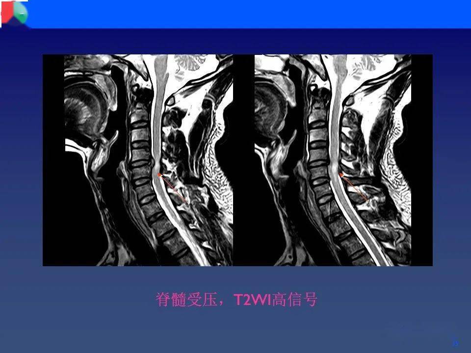 颈椎病影像再认识