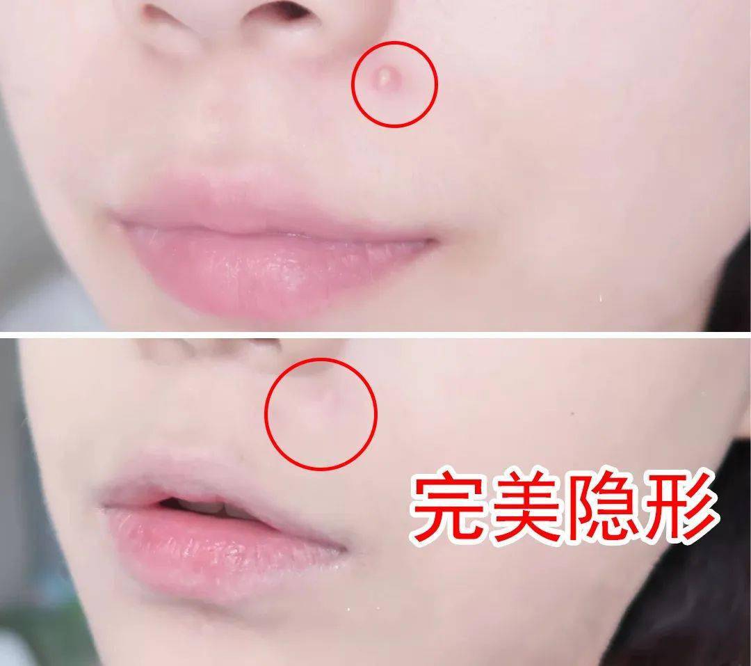 痘痘|“拔”出黄脓，快速消痘！让肌肤变成“白煮蛋”，就是这么简单！